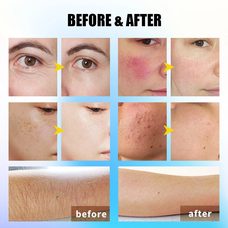 Laser-hair-removal-machine-tip-showing-treatment-area - HUIMAIN Laser hair removal machine tip showing treatment area - HUIMAIN