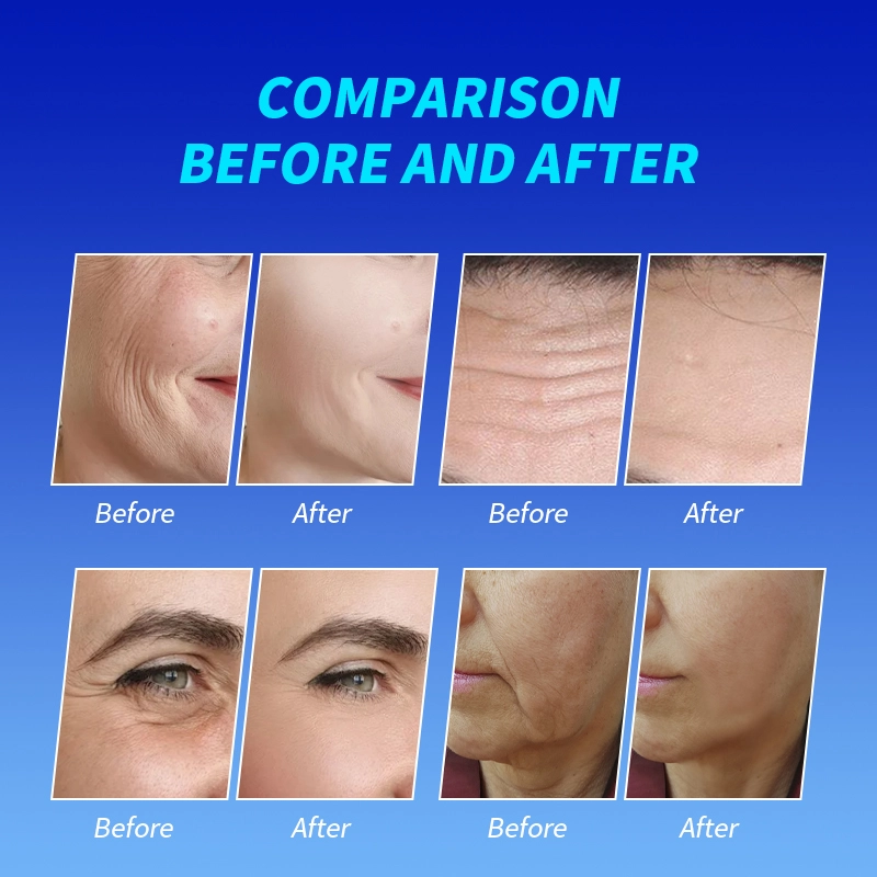 Professional EMS face lifting machine for collagen stimulation - HUIMAIN