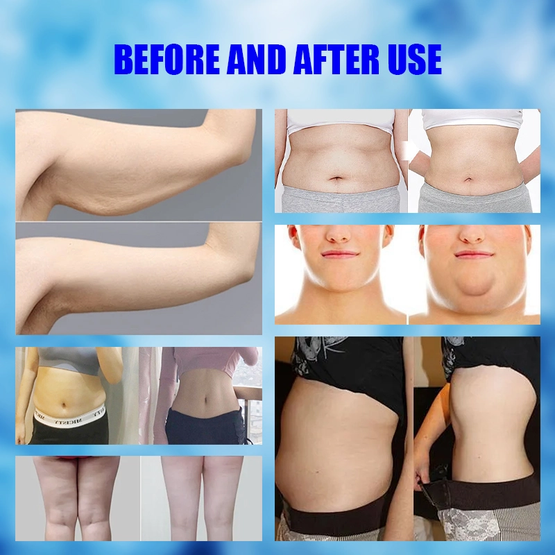 cryolipolysis - HUIMAIN