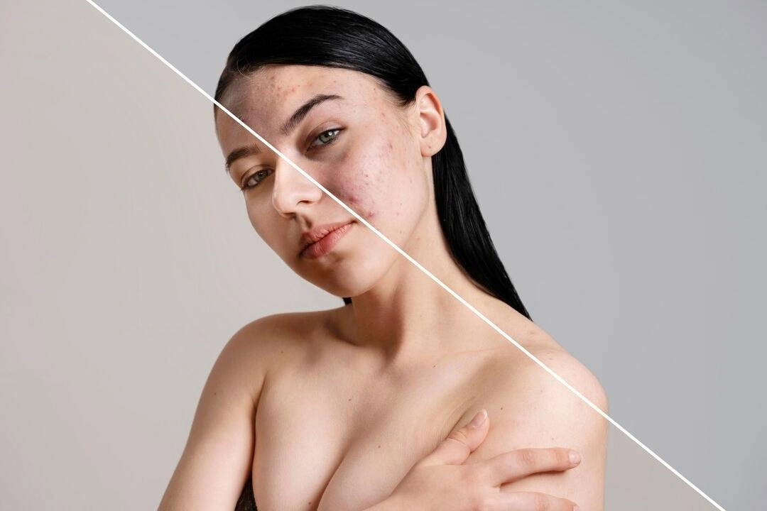 Acne & Pigmentation Treatment - HUIMAIN