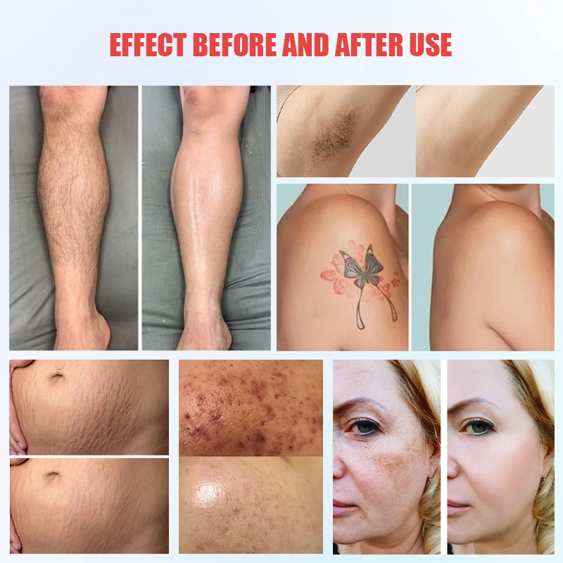 Dual-wavelength-diode-and-picosecond-laser-system-for-tattoo-removal-and-skin-rejuvenation - HUIMAIN Dual-wavelength diode and picosecond laser system for tattoo removal and skin rejuvenation - HUIMAIN