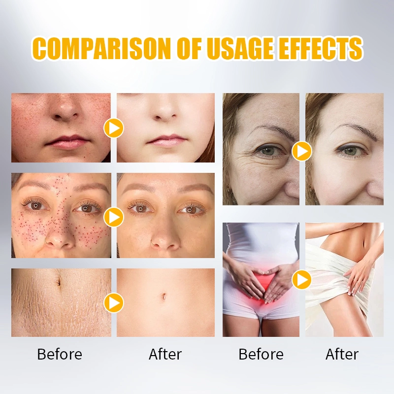 Fractional-CO2-Laser-Technology-for-stretch-mark-removal - HUIMAIN Fractional CO2 Laser Technology for stretch mark removal - HUIMAIN